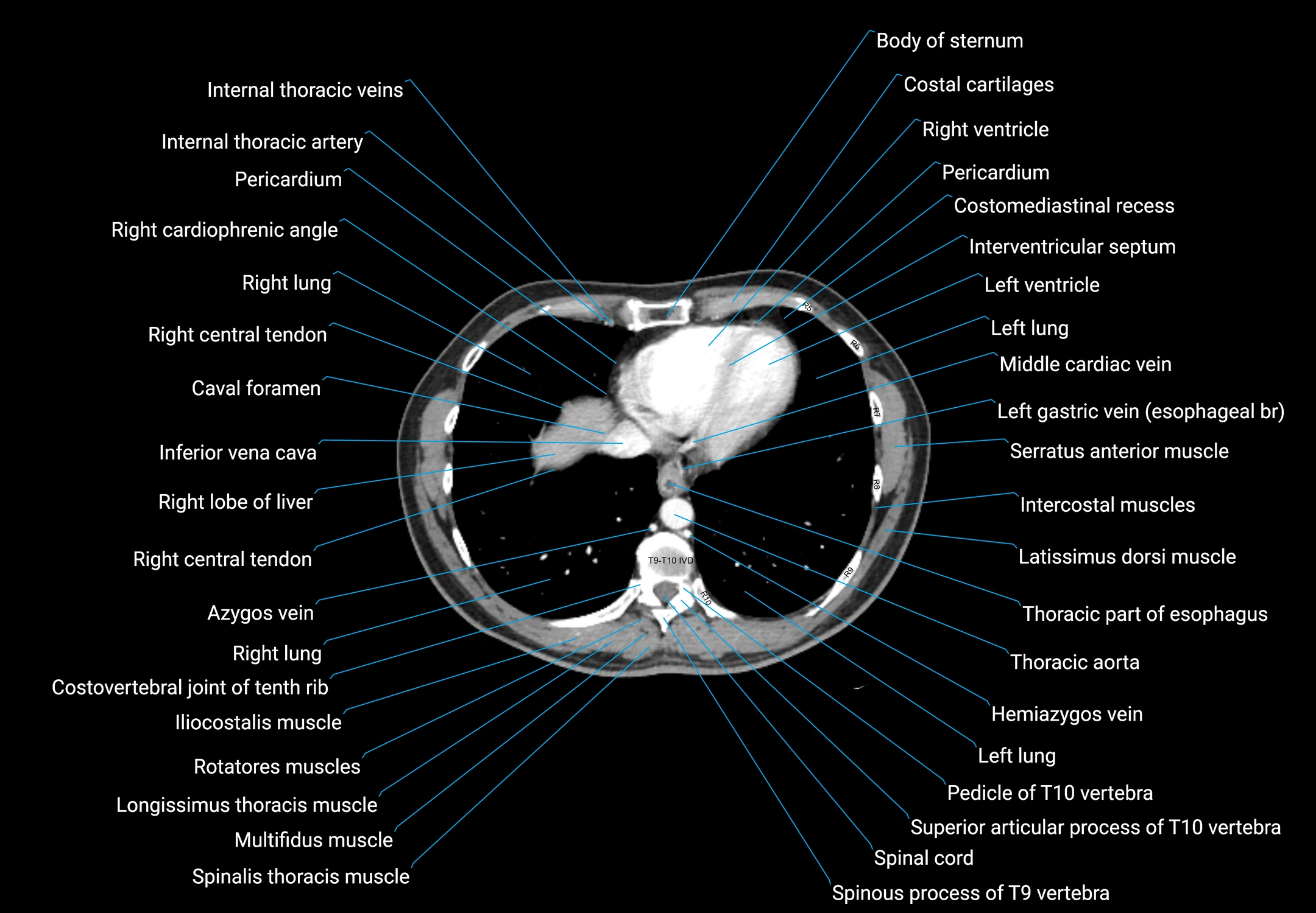 CT male pelvis axial cross sectional anatomy labelled radiology image -00009.webp